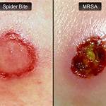 //reforcerestoration.com/wp-content/uploads/2024/01/ReForce-Restoration-MRSA-vs-Spider-Bite.jpg